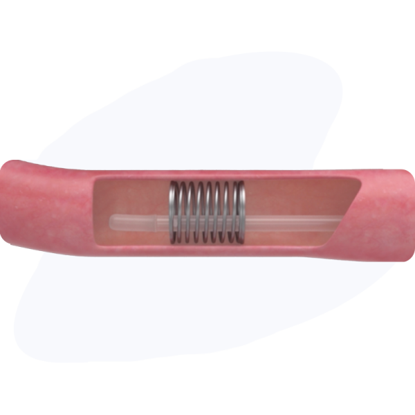 Eclipse-Regenesis-Web-V2---Short-bowl-Syndrome-Medtech-Solutions-IMG15