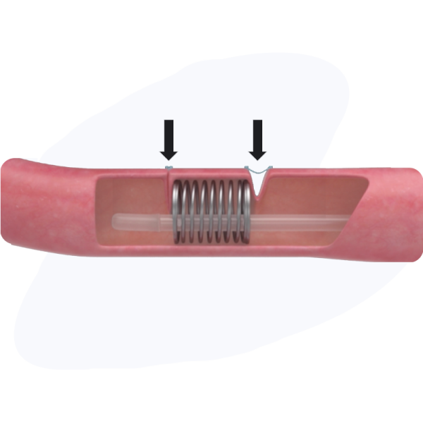 Eclipse-Regenesis-Web-V2---Short-bowl-Syndrome-Medtech-Solutions-IMG16