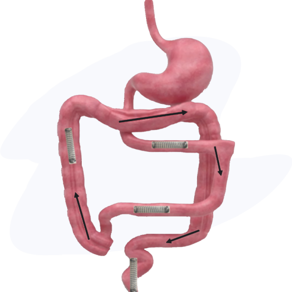 Eclipse-Regenesis-Web-V2---Short-bowl-Syndrome-Medtech-Solutions-IMG21